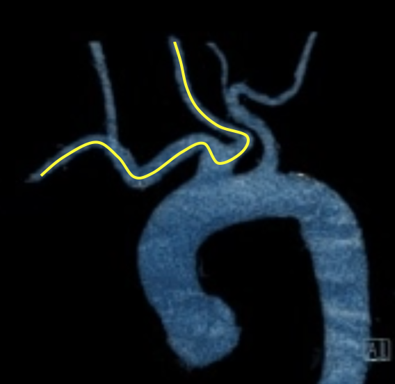 Mechanical Thrombectomy in Nighttime Hours: Is There a Difference