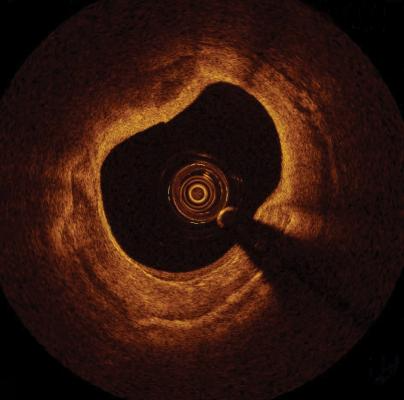 https://www.dicardiology.com/sites/default/files/styles/content_feed_large_new/public/OCT%20intravascular%20image%20of%20circumfernetial_calcium_from%20St%20Jude%20Medical%20PR.jpg?itok=YuVXoXv3