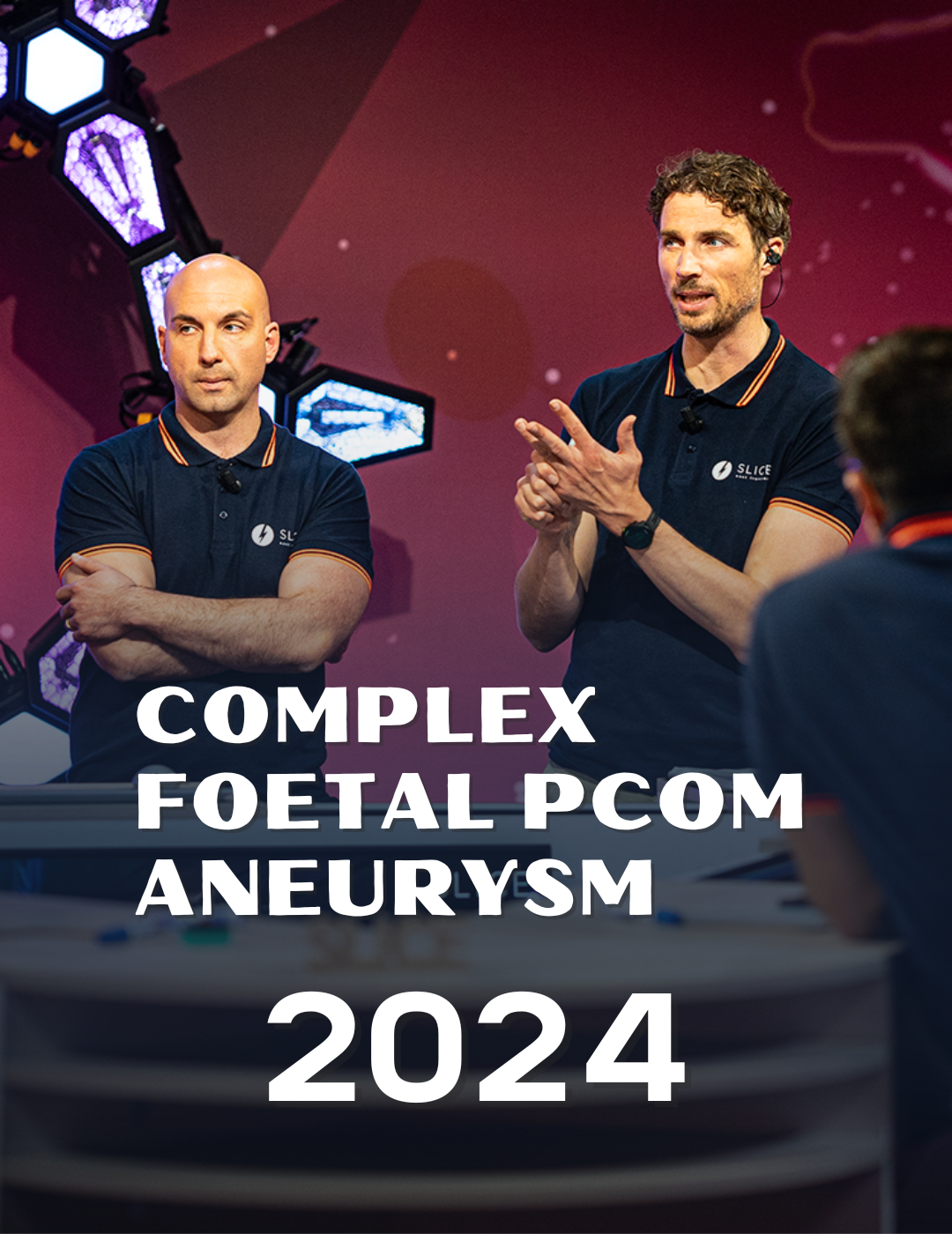 Complex foetal Pcom aneurysm 2024