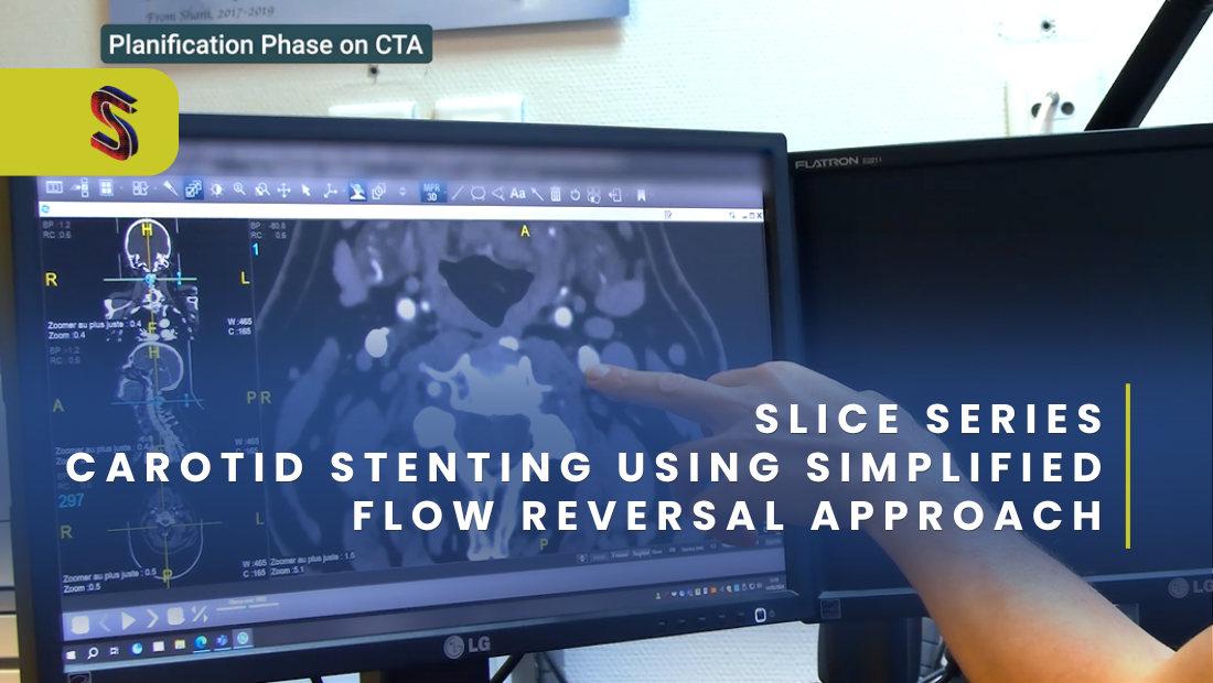 SLICE SERIE : Carotid stenting using simplified flow reversal approach